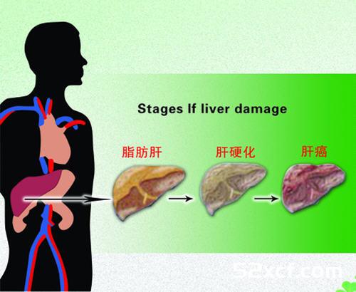 脂肪肝能吃肉吗？得了脂肪肝可不可以吃肉？