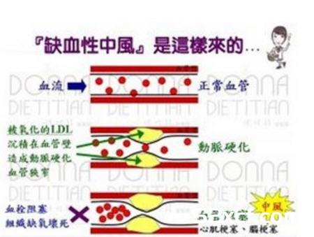 多吃大蒜、鱼油保肝降脂让你远离缺血性中风