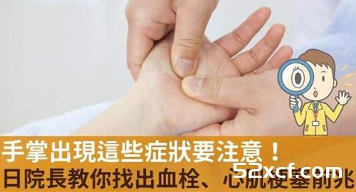 手掌出现这些症状要注意！日院长教你找出血栓、心肌梗塞前兆！